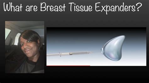 breast expansion meaning|Breast Tissue Expander: What is It & Complications